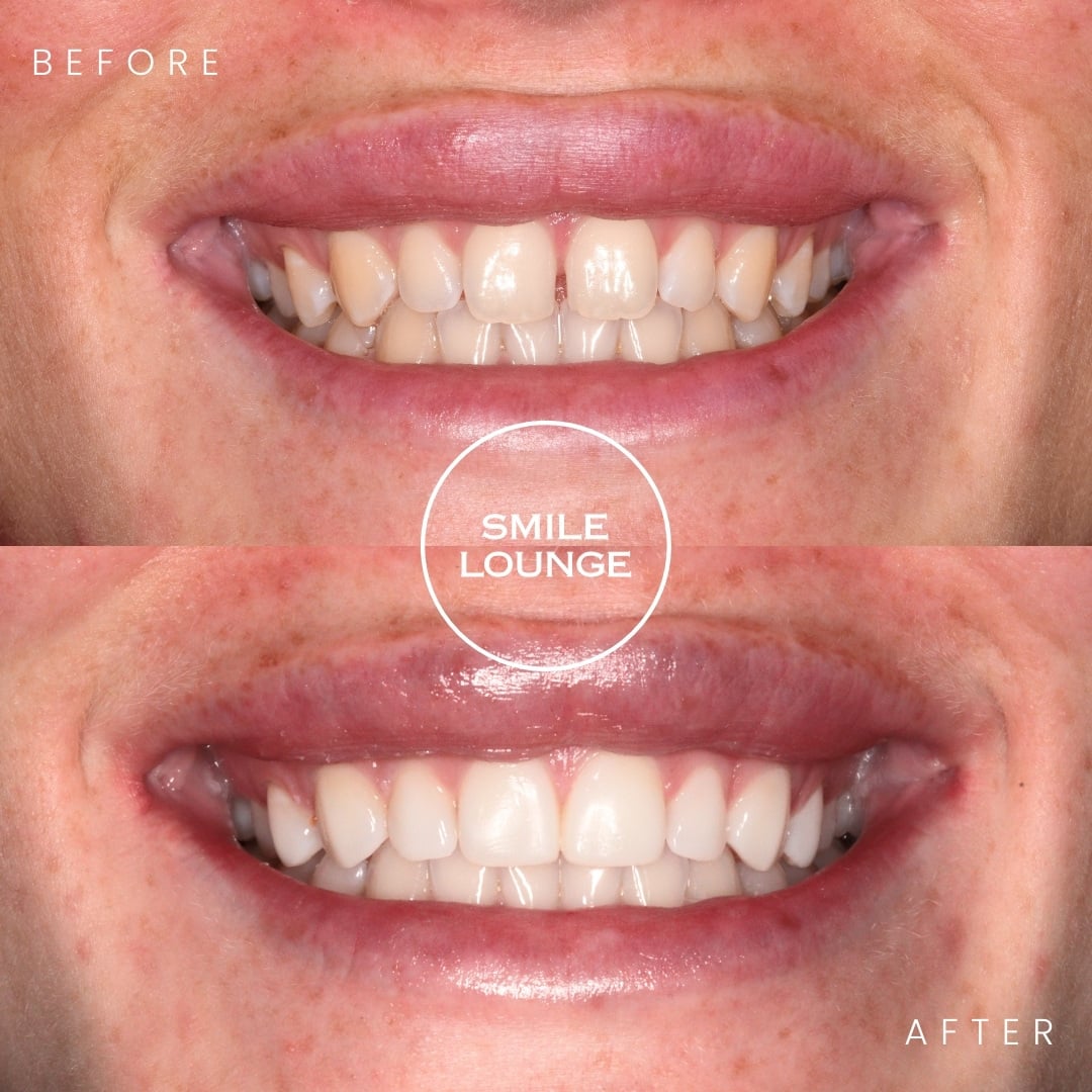 Composite Bonding Case Note South East Melbourne