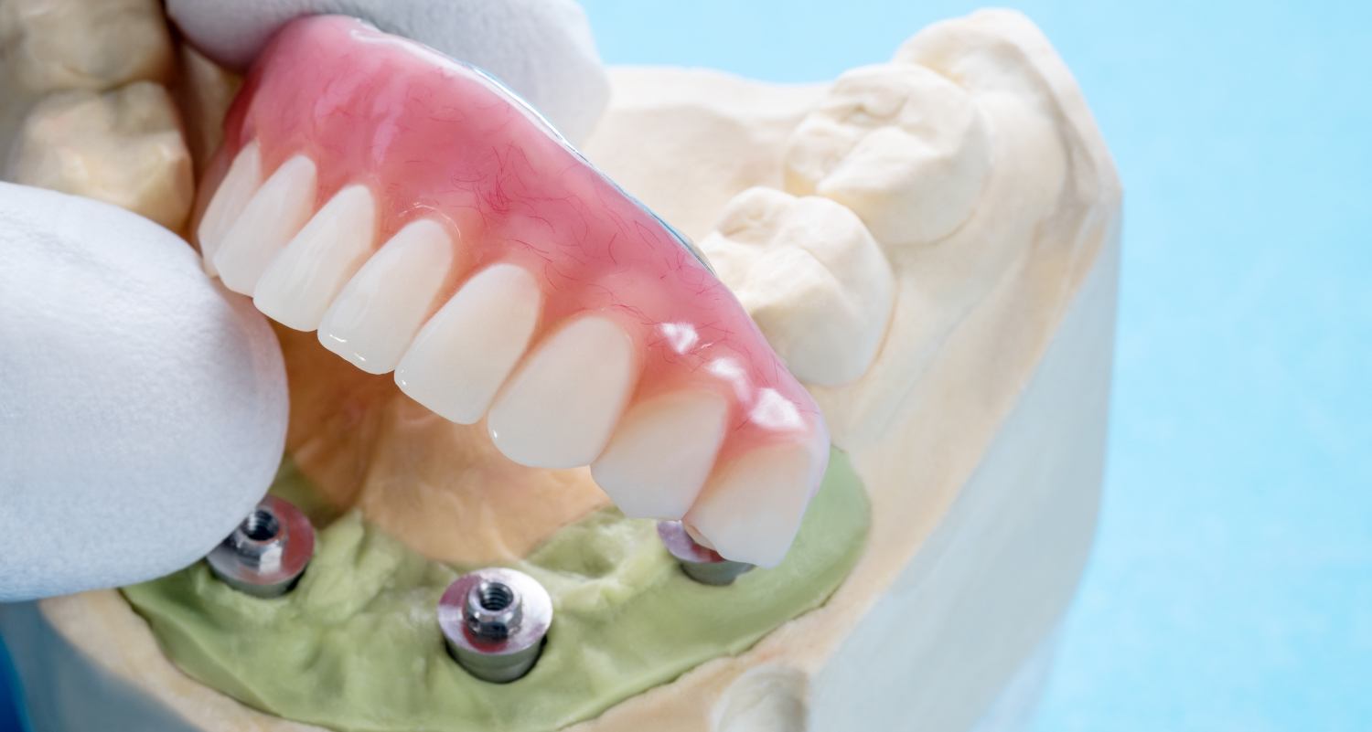 Can All-on-4 Significantly Improve Chewing Efficiency and Quality of Life?