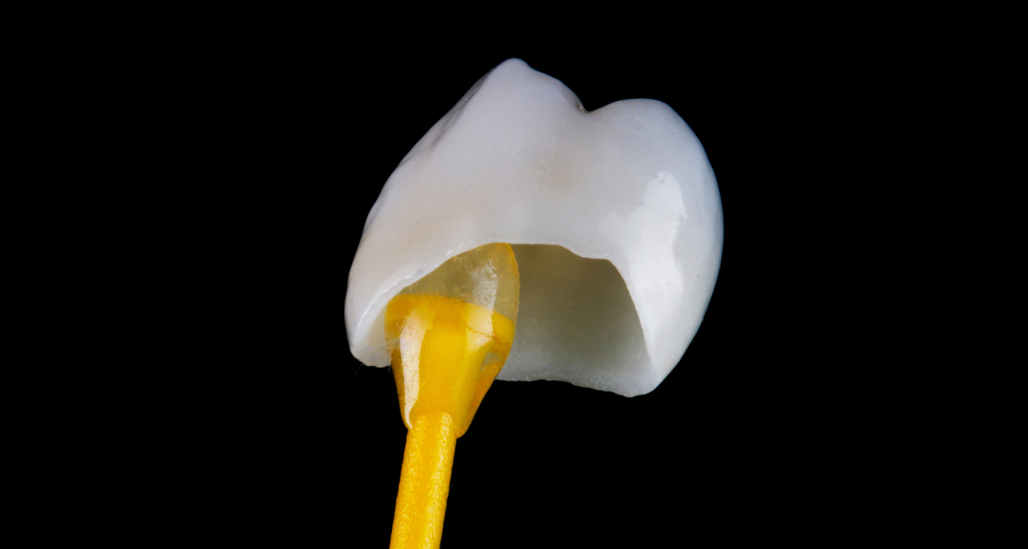 What Are the Aesthetic and Functional Benefits of CEREC Crowns vs Traditional Crowns?