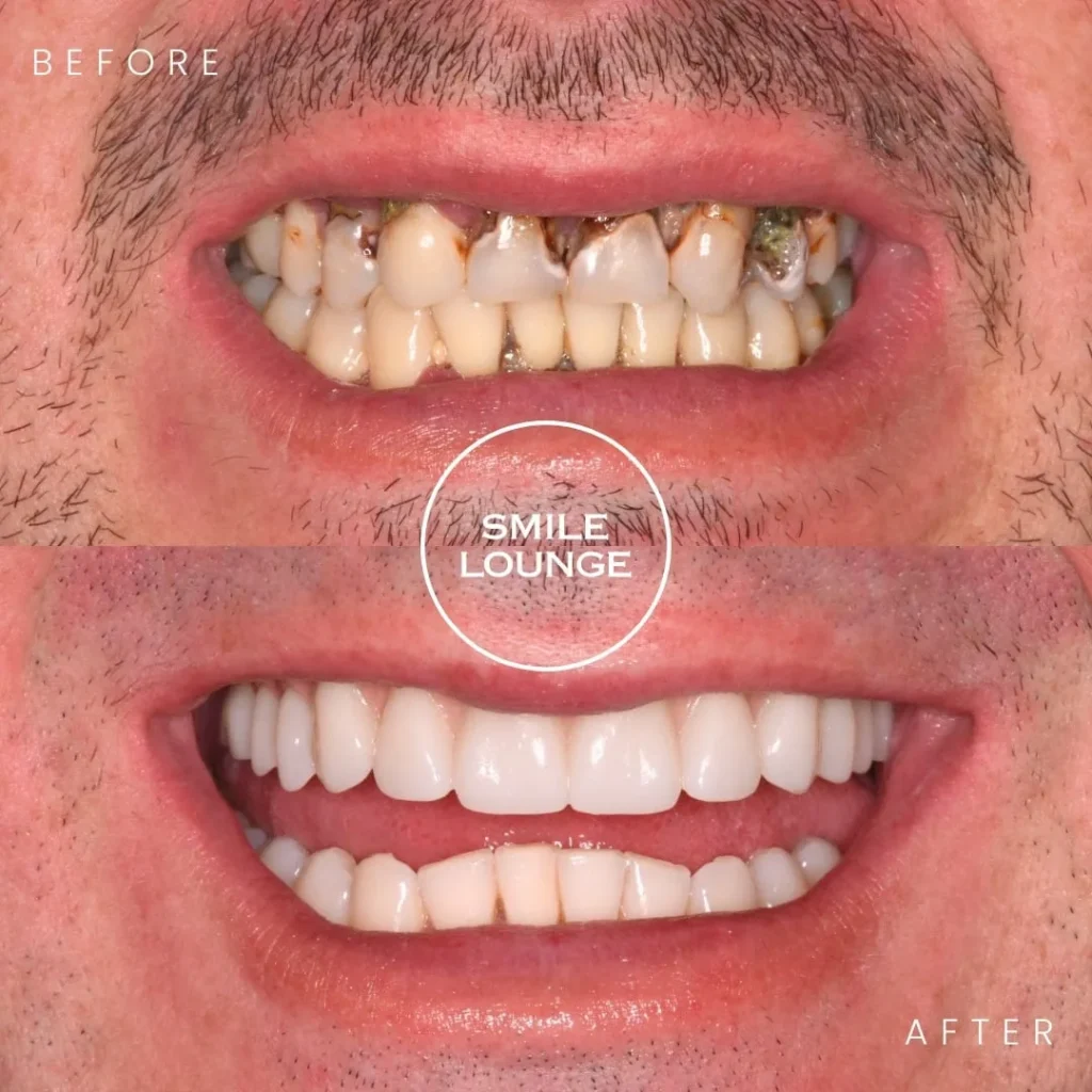 All-on-4 Full Arch Restoration Case Note Narre Warren
