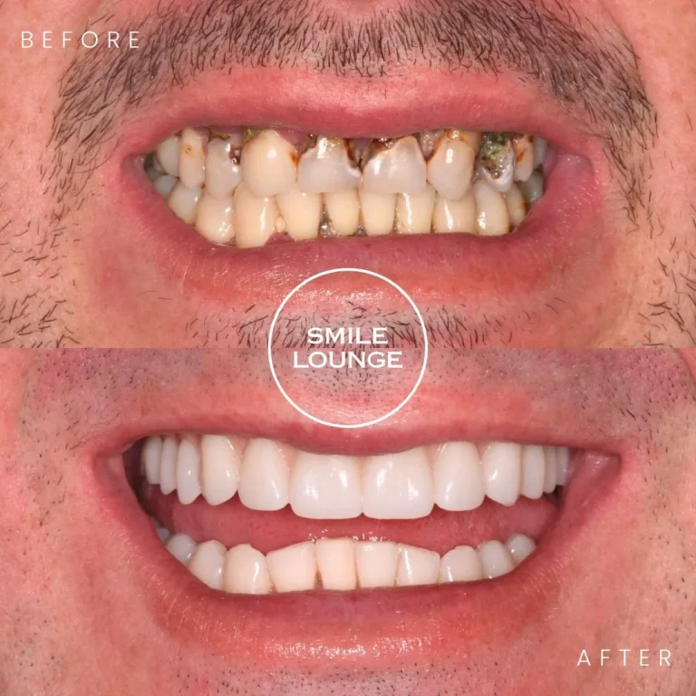 All-on-4 Full Arch Restoration Case Note Narre Warren