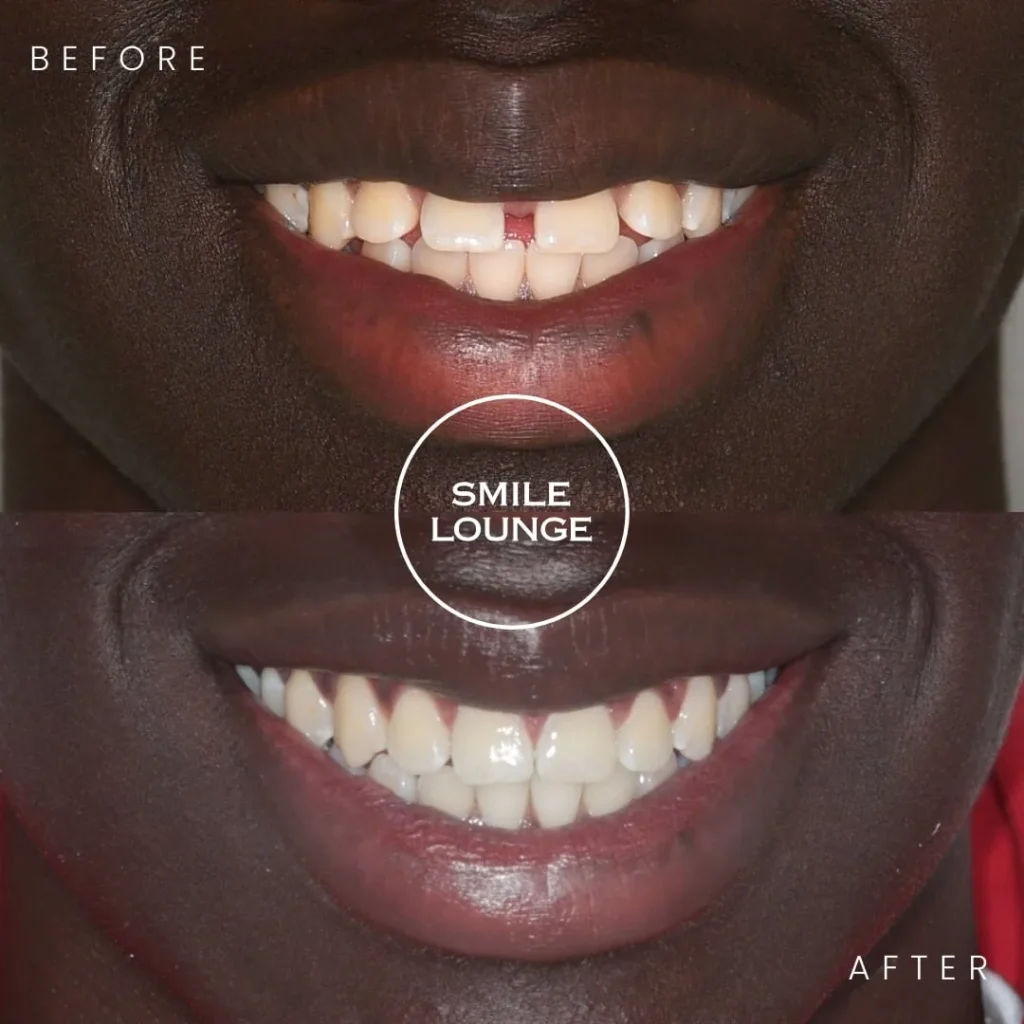 Invisalign Diastema Closure Case Note Cranbourne North