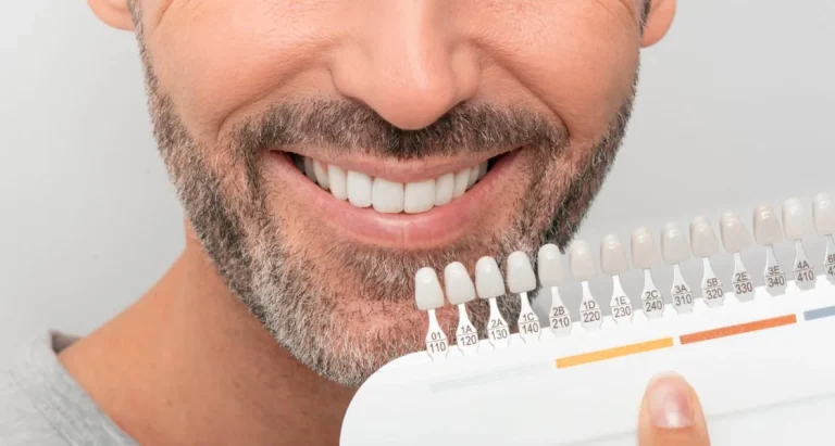 How Custom-Fitted Trays Deliver Superior Take-Home Teeth Whitening Results