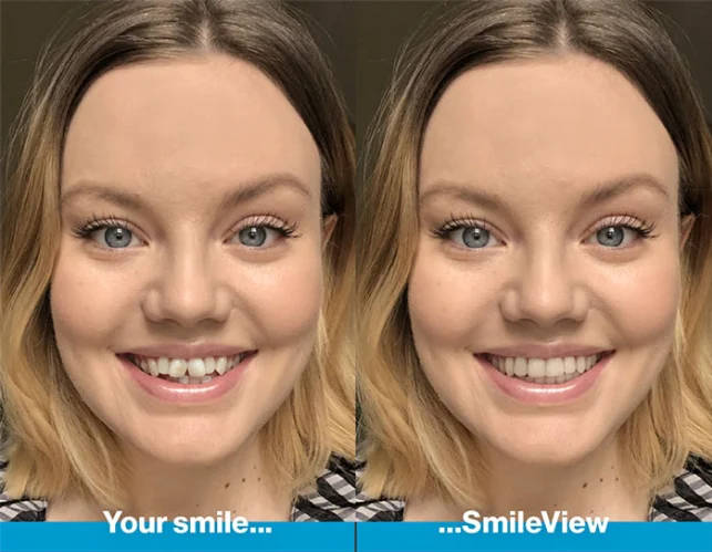 Invisalign clear aligners fitted at Smile Lounge in Berwick