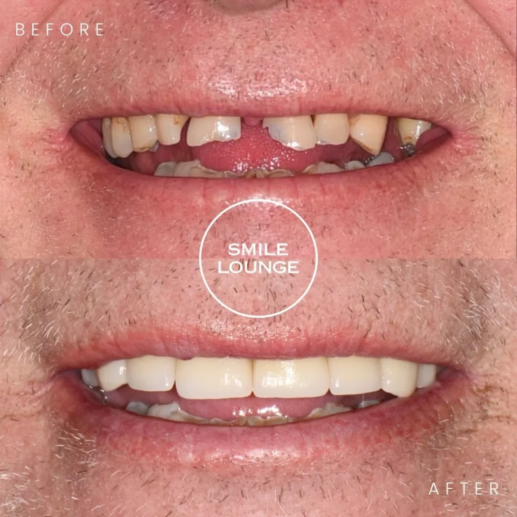 Comprehensive Crown and Bridge Restoration Case Note Beaconsfield