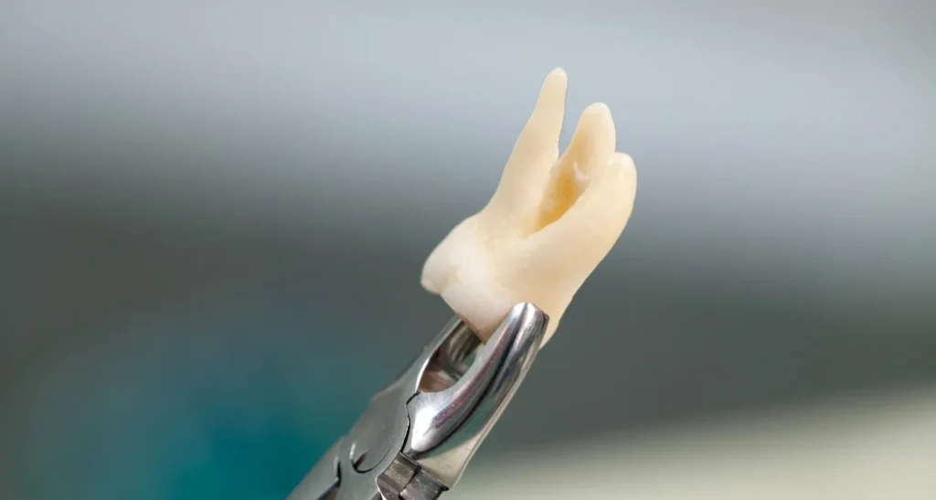 Why Dentists May Recommend Wisdom Teeth Removal Before Problems Occur