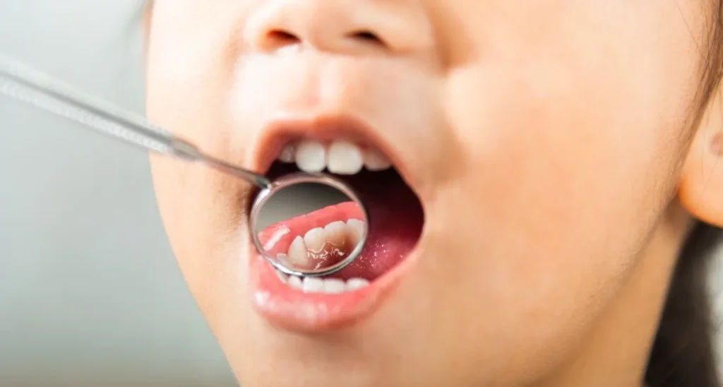 What Causes Kids Cavities and How Can You Prevent Them?