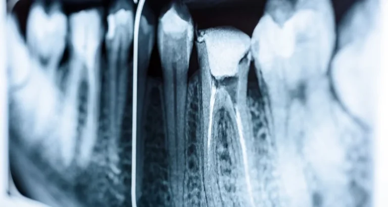 When Is Root Canal Treatment Necessary to Save Your Infected Tooth?