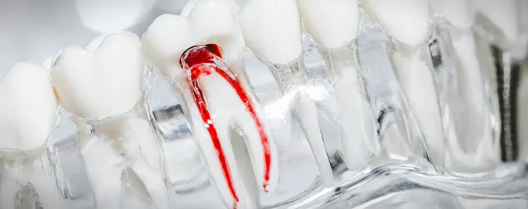 Root canal treatment at Smile Lounge, Narre Warren