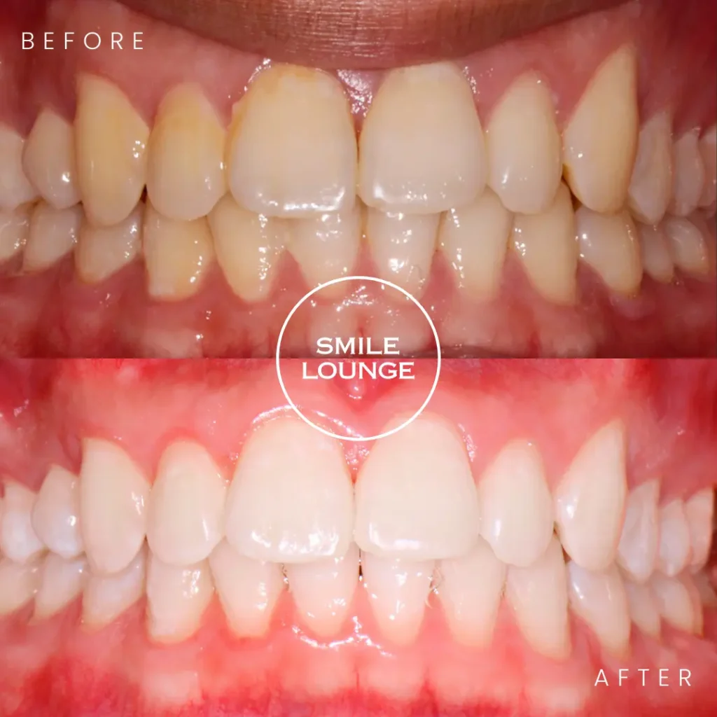 Before and after professional teeth whitening at Smile Lounge, Narre Warren