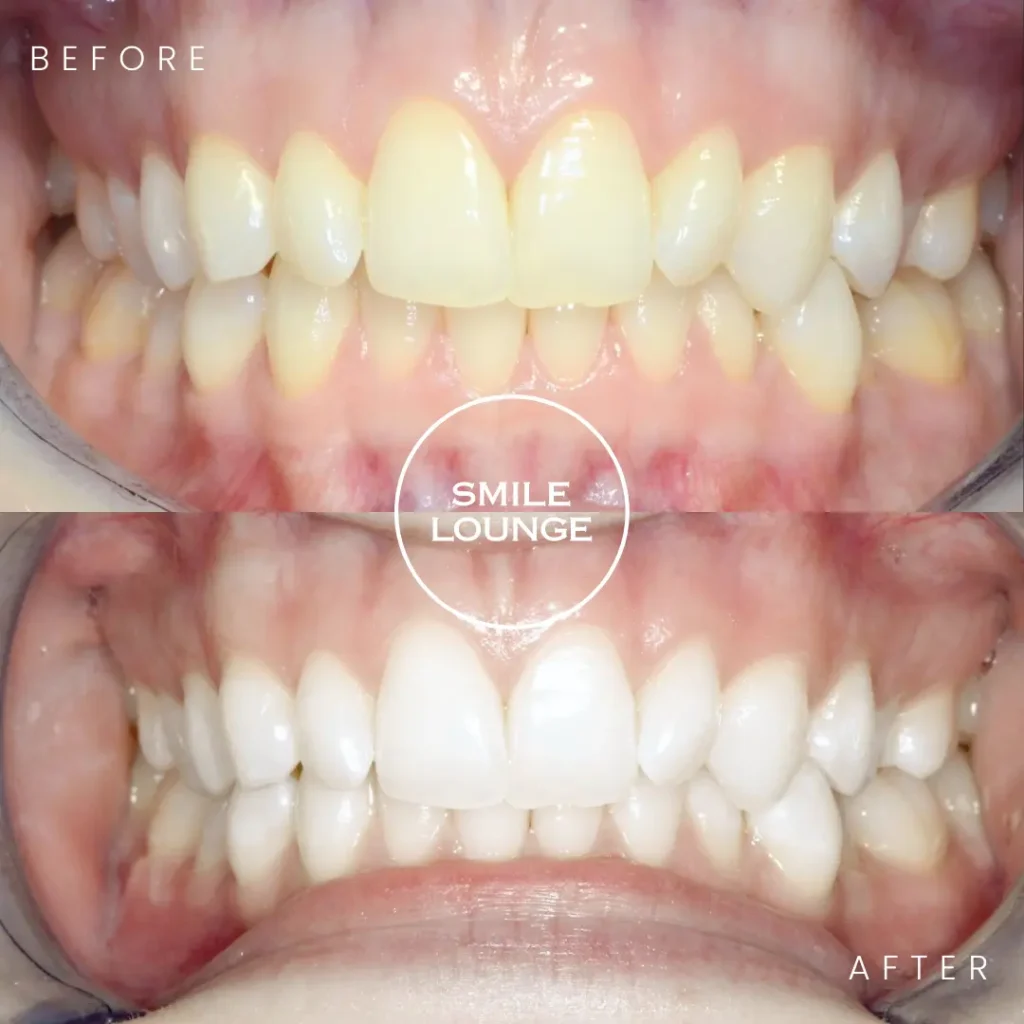 Before and after professional teeth whitening at Smile Lounge, Narre Warren