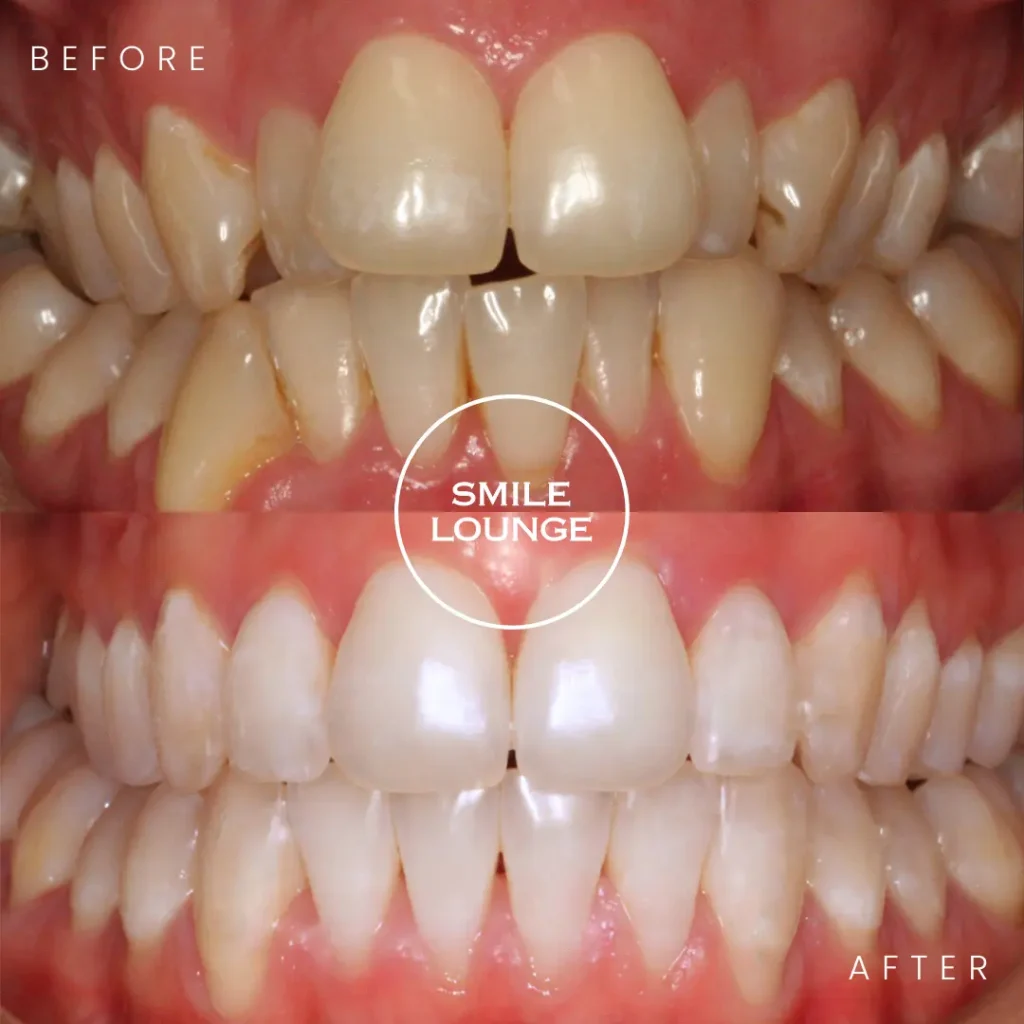 Before and after professional teeth whitening at Smile Lounge, Narre Warren