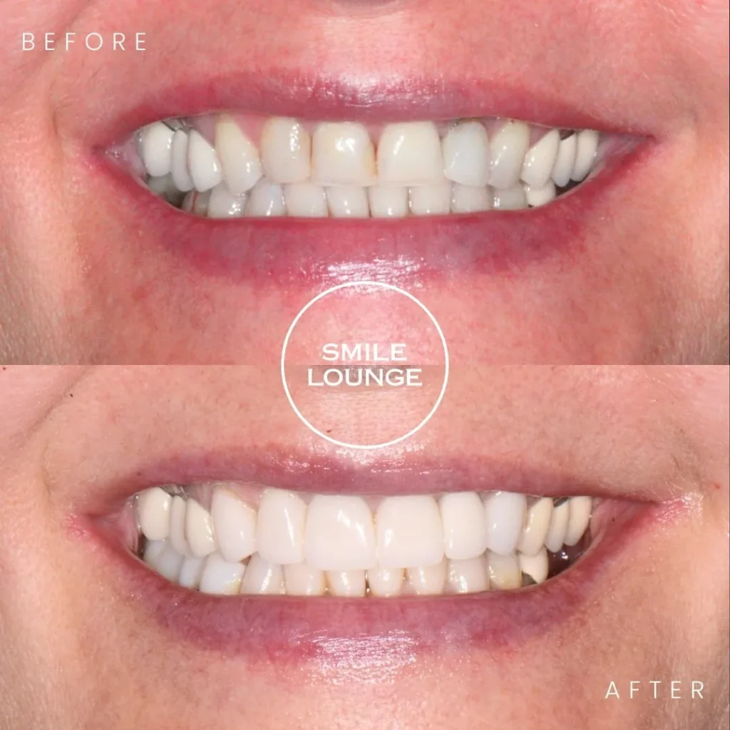 Close-up before and after bone grafting, dental implants, CEREC crowns and porcelain veneers at Smile Lounge, Narre Warren