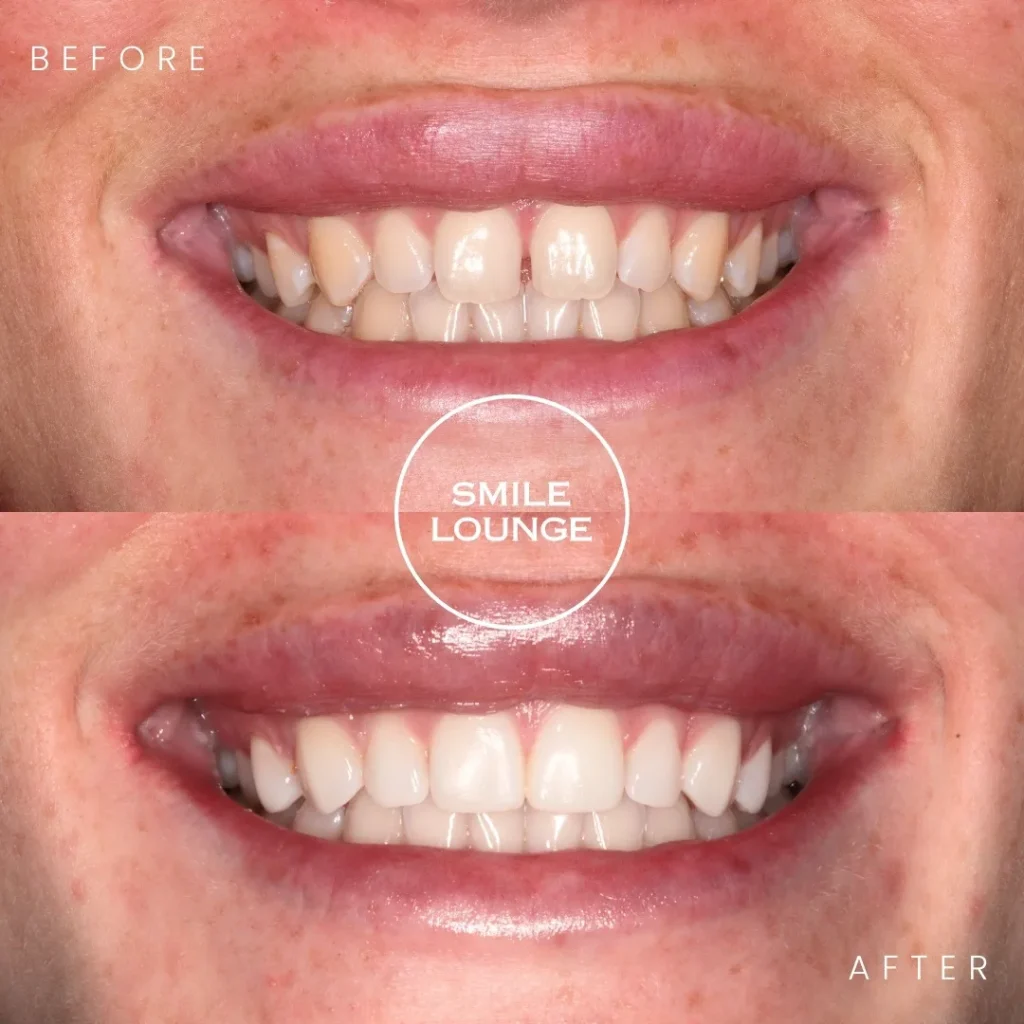 Close-up before and after composite bonding at Smile Lounge, Narre Warren