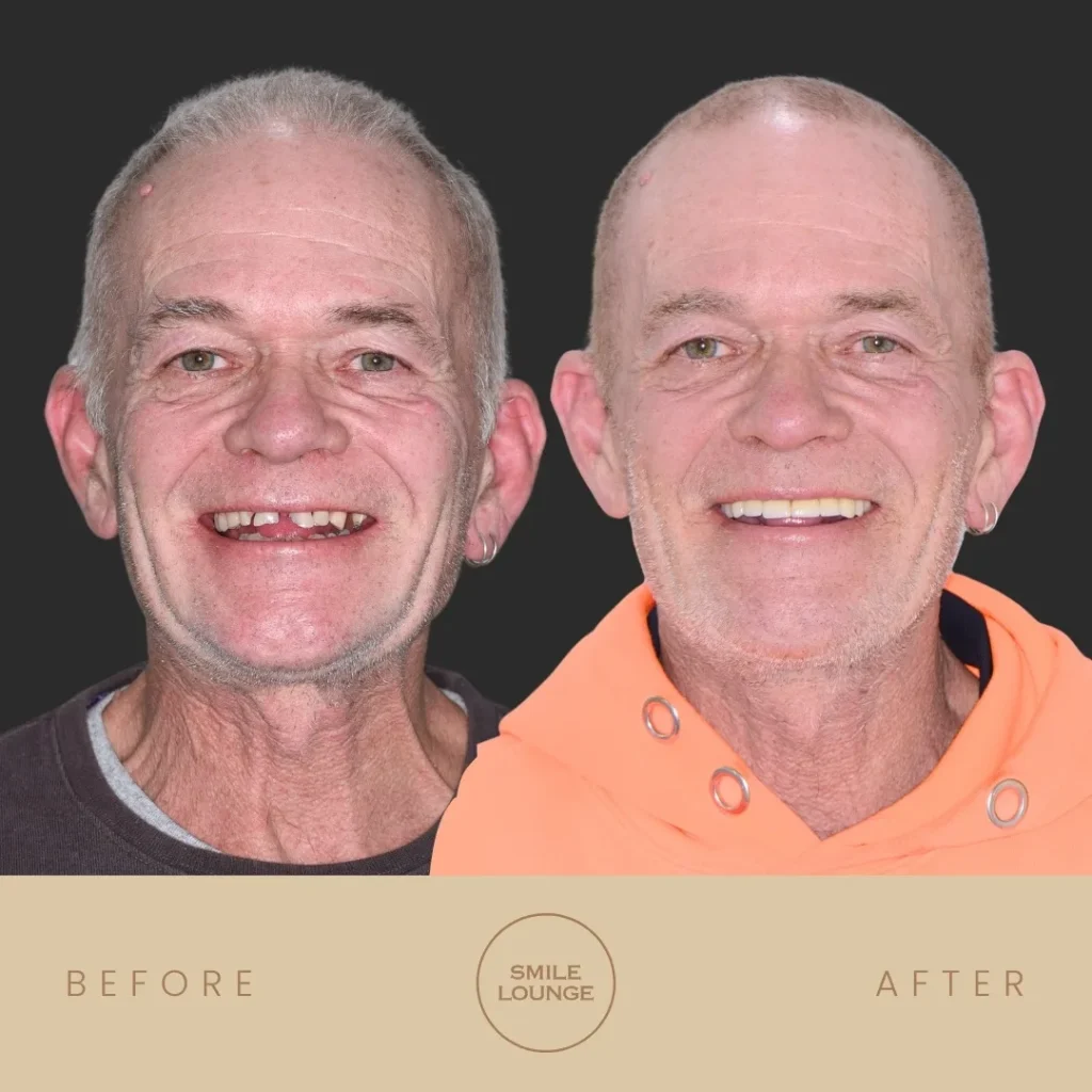 Close-up before and after dental crowns and bridges at Smile Lounge, Narre Warren