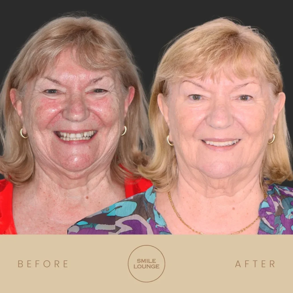 Close-up before and after gum treatment and porcelain crowns at Smile Lounge, Narre Warren