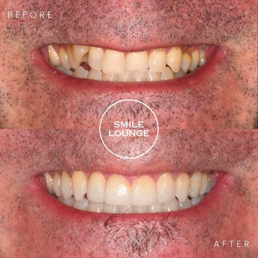 Close-up before and after Invisalign and porcelain veneers at Smile Lounge, Narre Warren