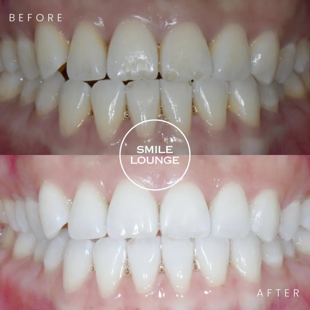 Before and after professional teeth whitening at Smile Lounge, Narre Warren