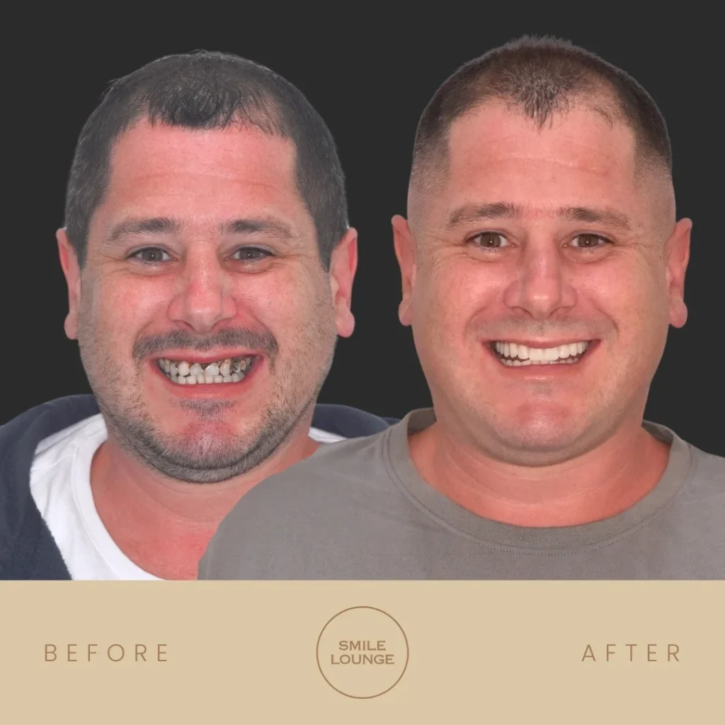 Before and after All-Teeth-On-4 dental implant smile makeover at Smile Lounge