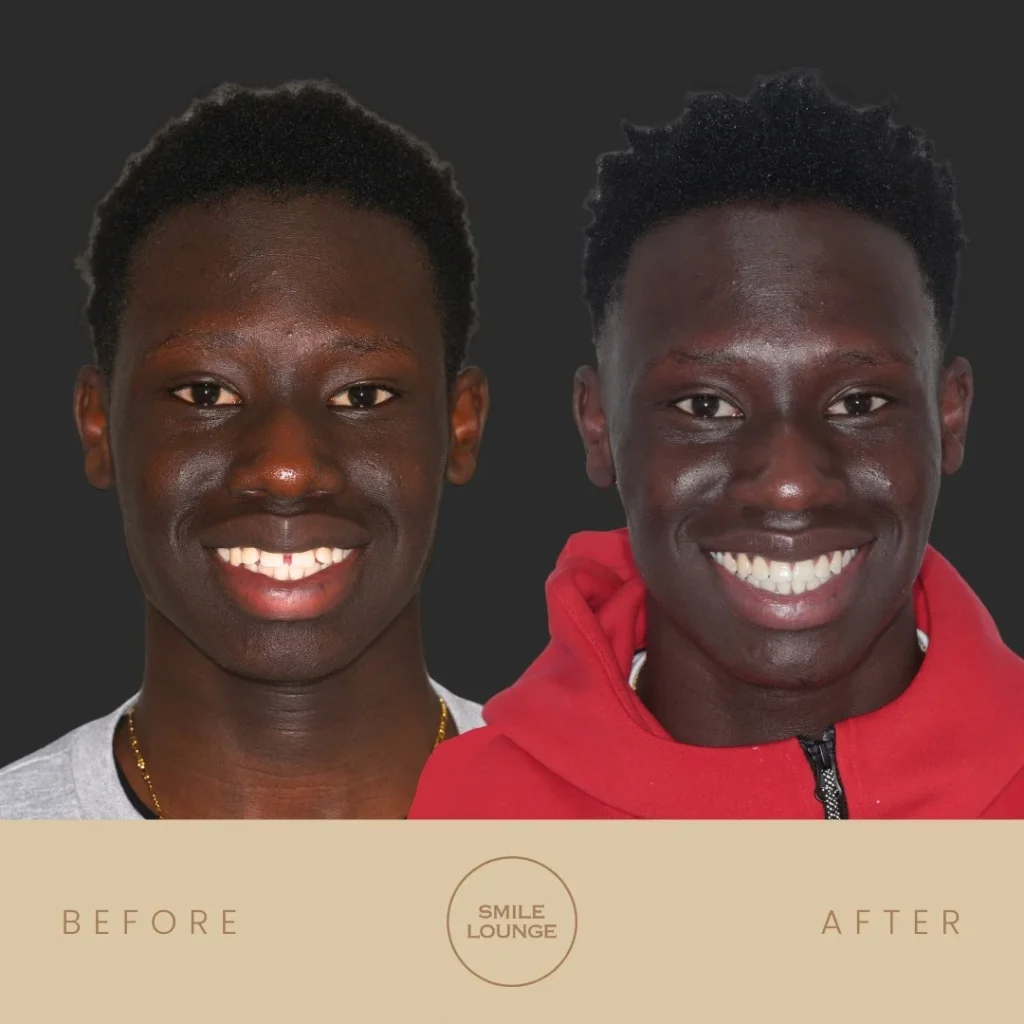 Before and after Invisalign clear aligner treatment at Smile Lounge