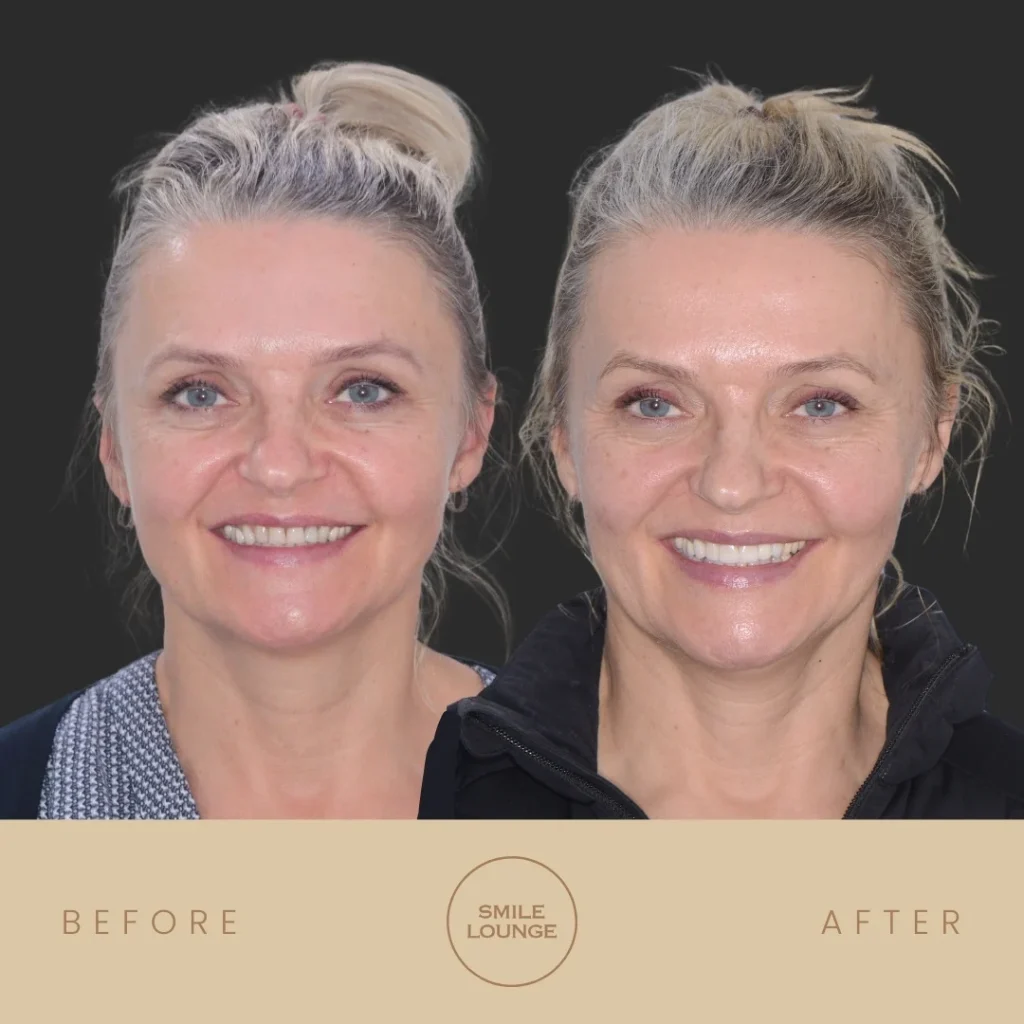 Before and after dental implants, crowns and porcelain veneers at Smile Lounge