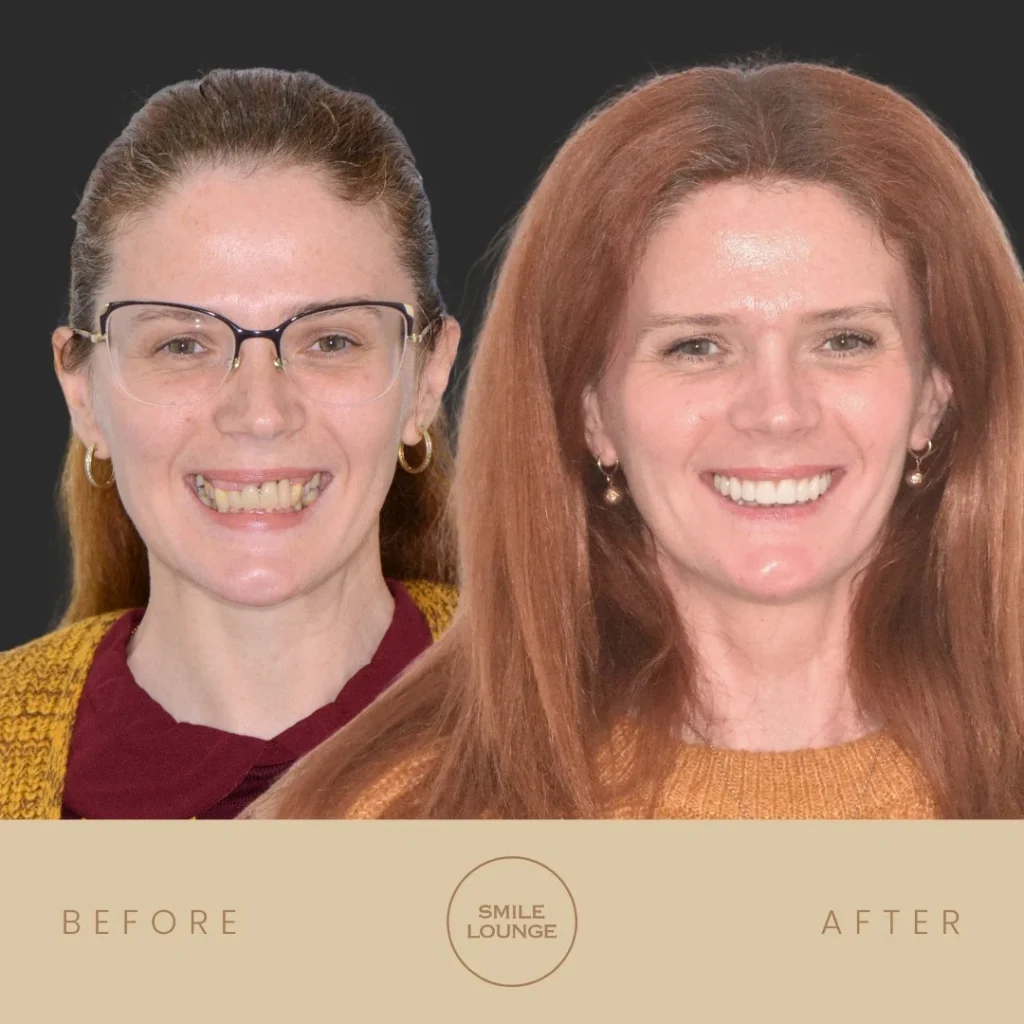 Before and after All-Teeth-On-4 implants with gum recontouring at Smile Lounge