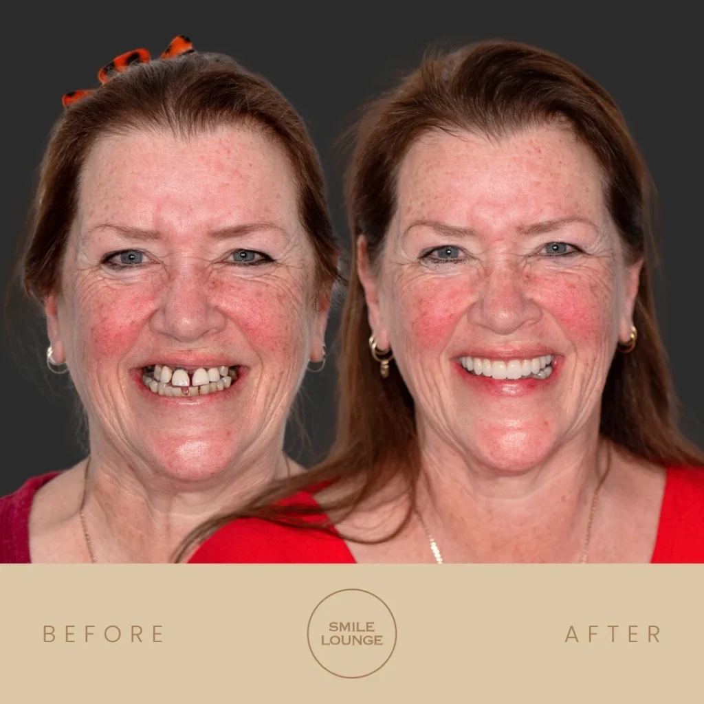 Before and after All-On-4 full-arch dental implant makeover at Smile Lounge