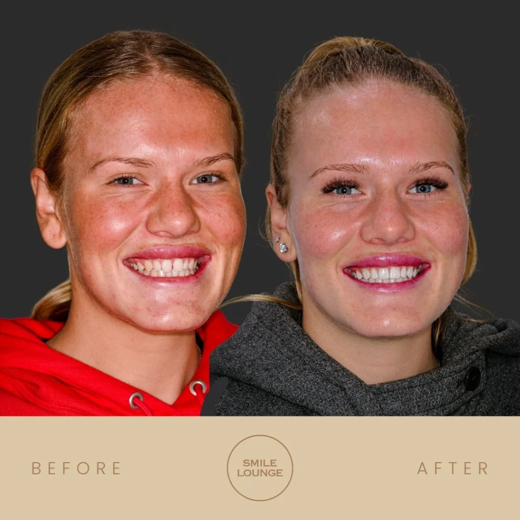 Before and after composite bonding smile makeover at Smile Lounge
