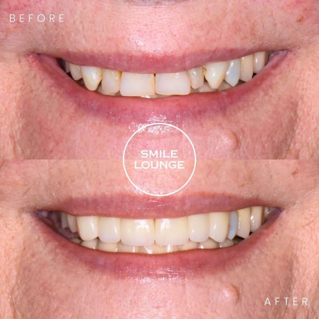 Before and after porcelain crowns smile makeover at Smile Lounge