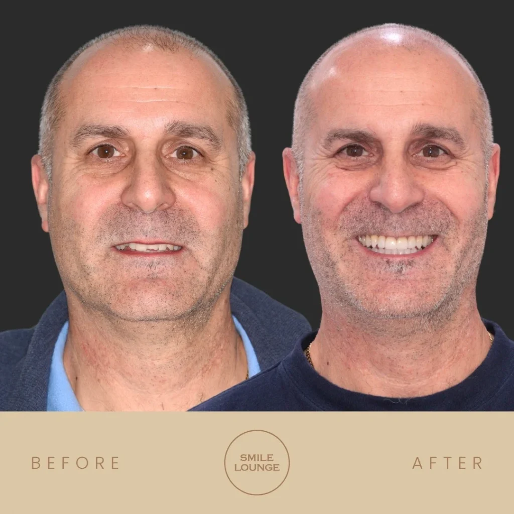 Before and after Invisalign and porcelain veneers smile makeover at Smile Lounge