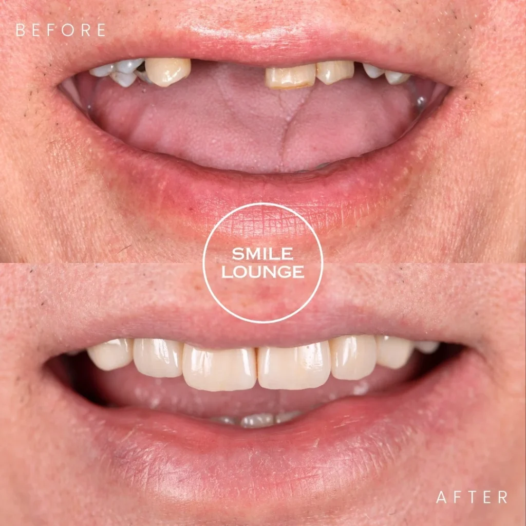 Before and after All-Teeth-On-4 full-arch implant restoration at Smile Lounge