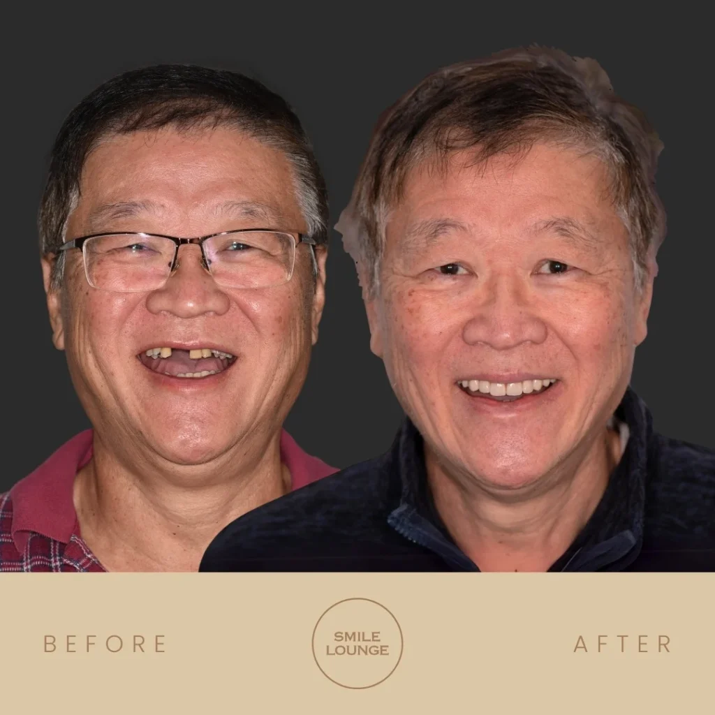 Before and after All-Teeth-On-4 full-arch implant restoration at Smile Lounge